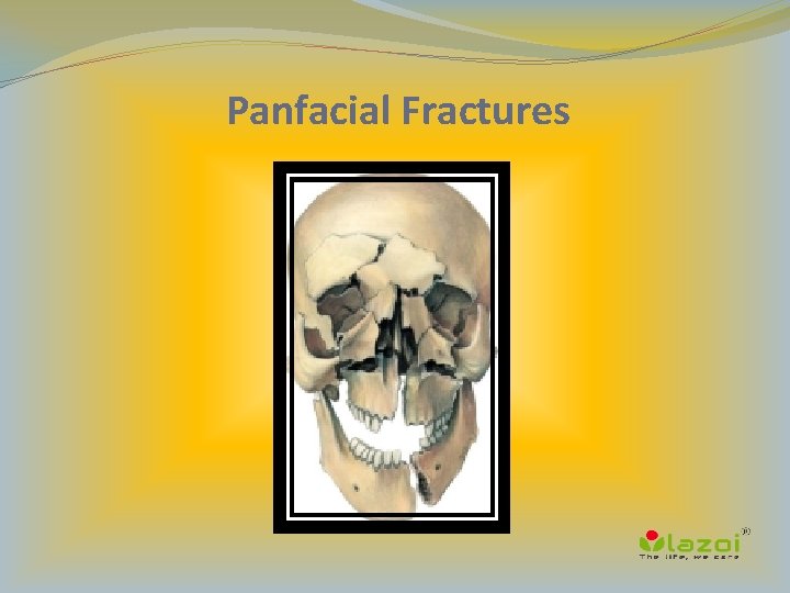 Panfacial Fractures 