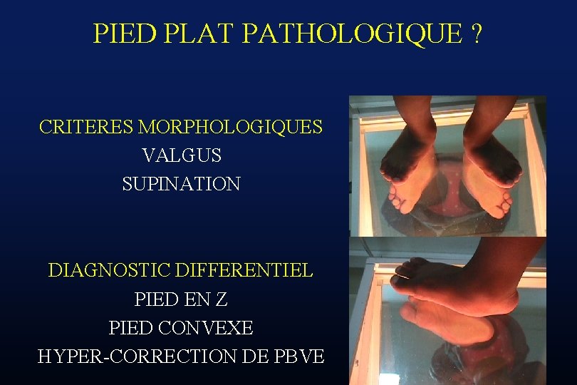 PIED PLAT PATHOLOGIQUE ? CRITERES MORPHOLOGIQUES VALGUS SUPINATION DIAGNOSTIC DIFFERENTIEL PIED EN Z PIED