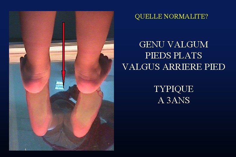 QUELLE NORMALITE? GENU VALGUM PIEDS PLATS VALGUS ARRIERE PIED TYPIQUE A 3 ANS 