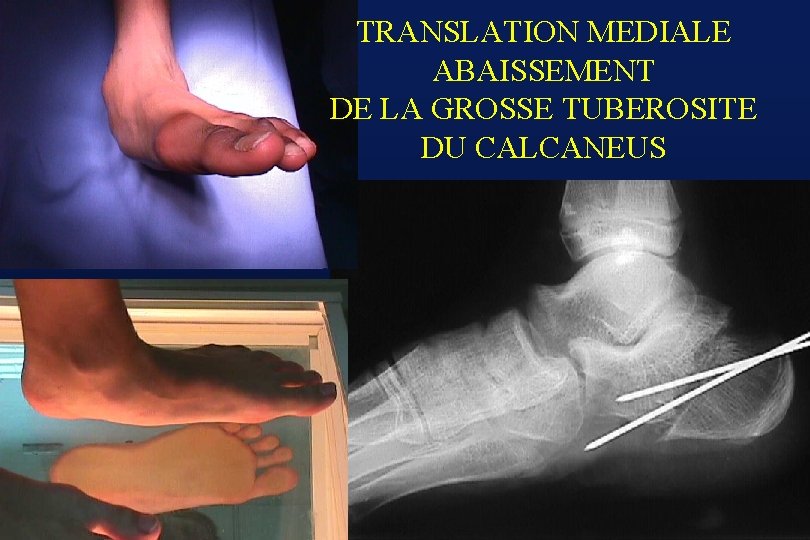 TRANSLATION MEDIALE ABAISSEMENT DE LA GROSSE TUBEROSITE DU CALCANEUS 