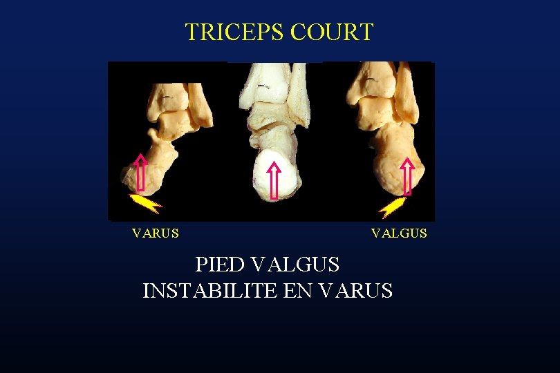 TRICEPS COURT VARUS VALGUS PIED VALGUS INSTABILITE EN VARUS 