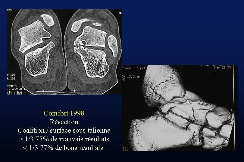 Comfort 1998 Résection Coalition / surface sous talienne > 1/3 75% de mauvais résultats