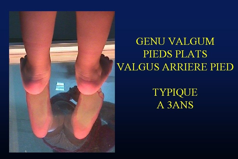 GENU VALGUM PIEDS PLATS VALGUS ARRIERE PIED TYPIQUE A 3 ANS 