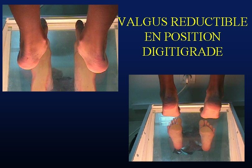 VALGUS REDUCTIBLE EN POSITION DIGITIGRADE 