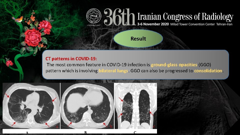 Result CT patterns in COVID-19: The most common feature in COVID-19 infection is ground-glass Result CT patterns in COVID-19: The most common feature in COVID-19 infection is ground-glass