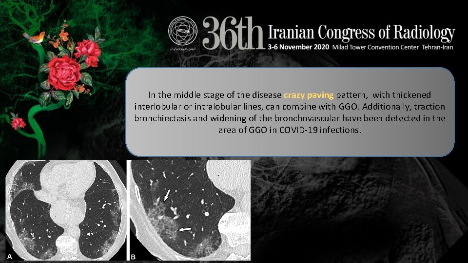 In the middle stage of the disease crazy paving pattern, with thickened interlobular or In the middle stage of the disease crazy paving pattern, with thickened interlobular or