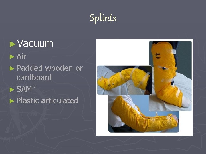 Splints ►Vacuum ► Air ► Padded wooden or cardboard ® ► SAM ► Plastic