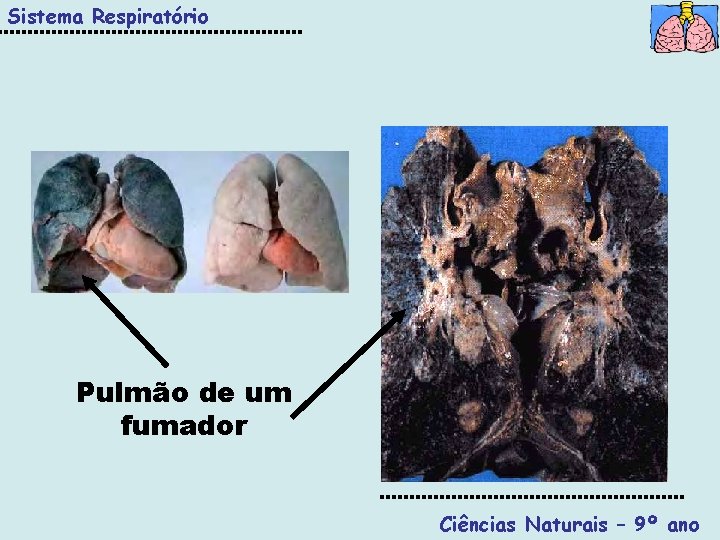 Sistema Respiratório Pulmão de um fumador Ciências Naturais – 9º ano 