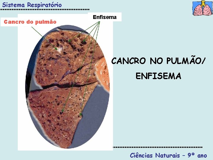 Sistema Respiratório Cancro do pulmão Enfisema CANCRO NO PULMÃO/ ENFISEMA Ciências Naturais – 9º