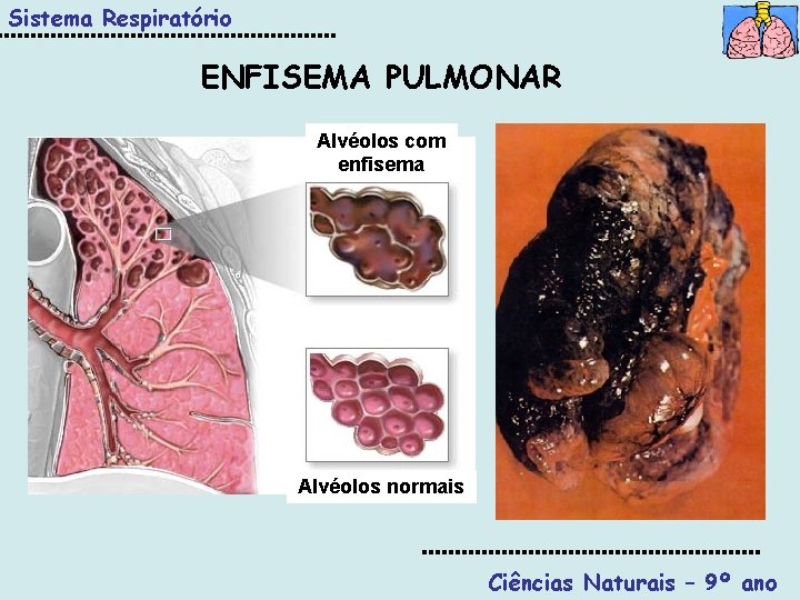 Sistema Respiratório ENFISEMA PULMONAR Alvéolos com enfisema Alvéolos normais Ciências Naturais – 9º ano