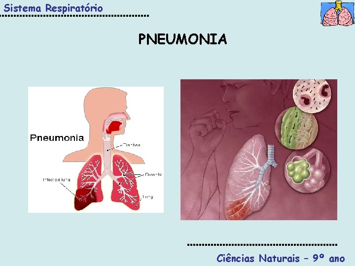 Sistema Respiratório PNEUMONIA Ciências Naturais – 9º ano 