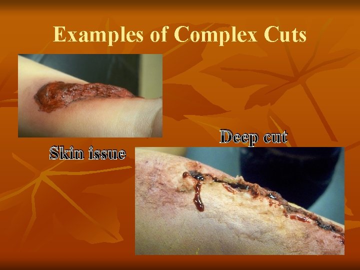 Examples of Complex Cuts Skin issue Deep cut 