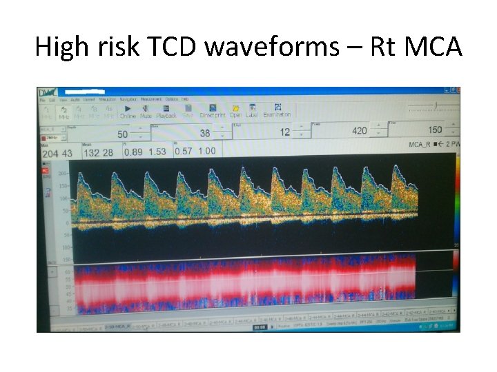 High risk TCD waveforms – Rt MCA 