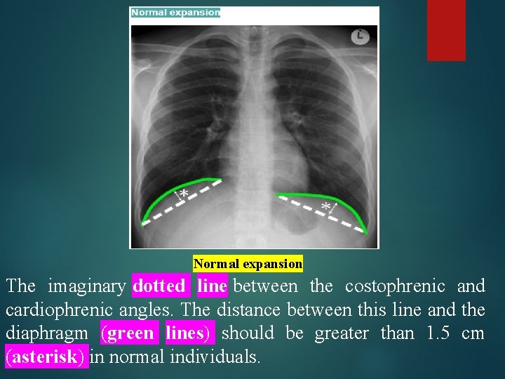 Chest Xray HOW TO INTERPRET CHEST XRAY By Chest Xray HOW TO INTERPRET CHEST XRAY By