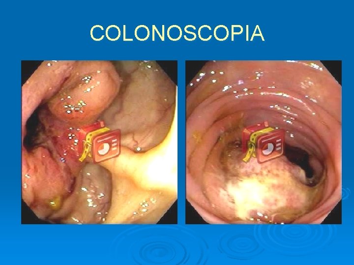 COLONOSCOPIA 