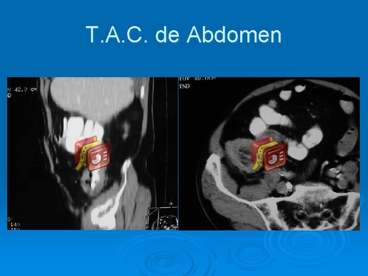 T. A. C. de Abdomen 