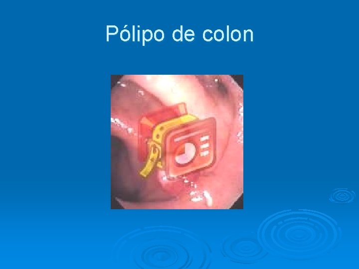 Pólipo de colon 