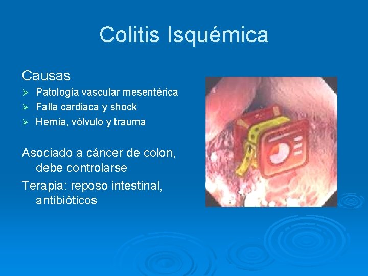 Colitis Isquémica Causas Patología vascular mesentérica Ø Falla cardiaca y shock Ø Hernia, vólvulo