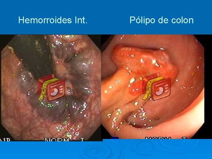 Hemorroides Int. Pólipo de colon 