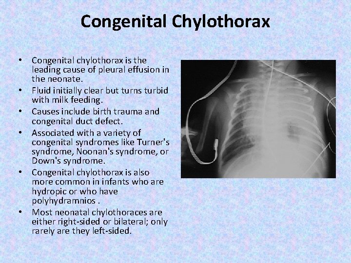 Congenital Chylothorax • Congenital chylothorax is the leading cause of pleural effusion in the