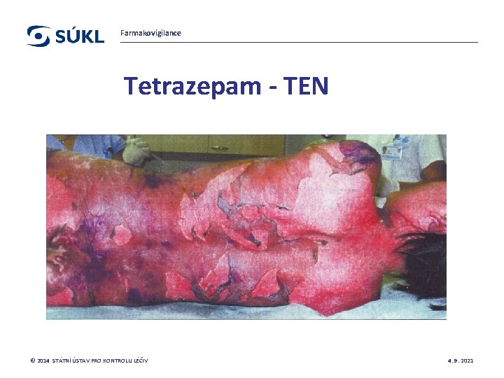 Farmakovigilance Tetrazepam - TEN © 2014 STÁTNÍ ÚSTAV PRO KONTROLU LÉČIV 4. 9. 2021