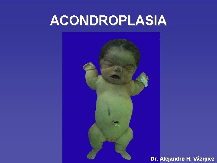 ACONDROPLASIA Dr. Alejandro H. Vázquez 