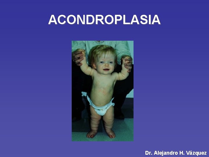 ACONDROPLASIA Dr. Alejandro H. Vázquez 