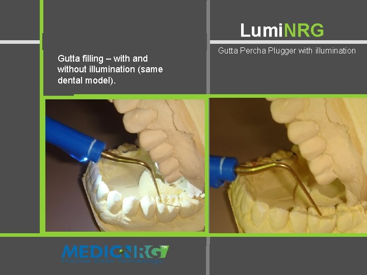 Lumi. NRG Gutta filling – with and without illumination (same dental model). Gutta Percha