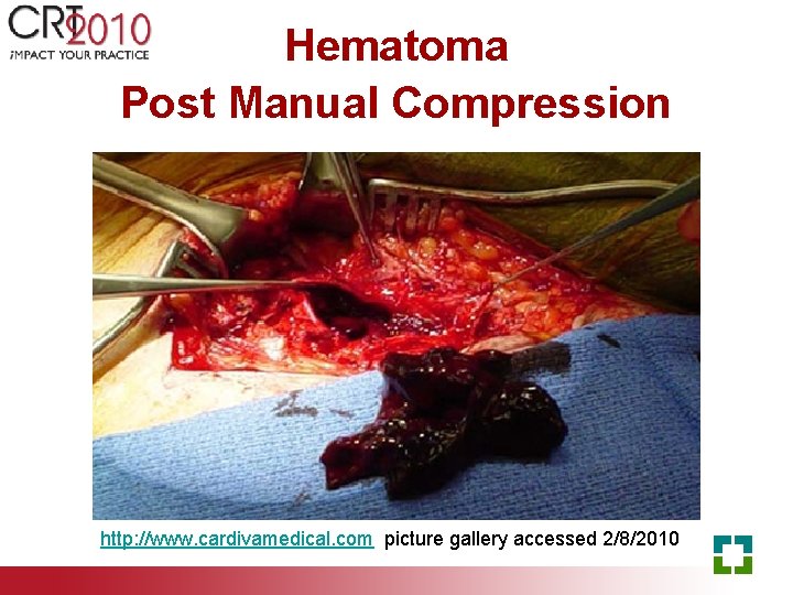 Hematoma Post Manual Compression http: //www. cardivamedical. com picture gallery accessed 2/8/2010 