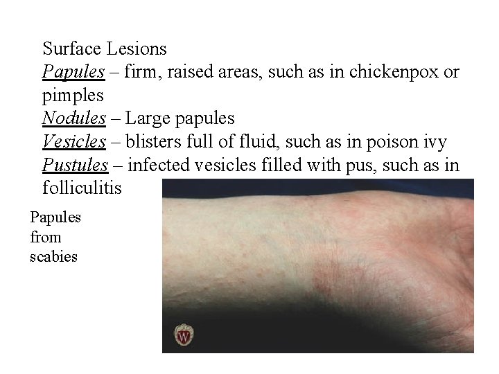 Surface Lesions Papules – firm, raised areas, such as in chickenpox or pimples Nodules