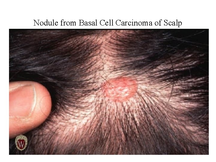 Nodule from Basal Cell Carcinoma of Scalp 