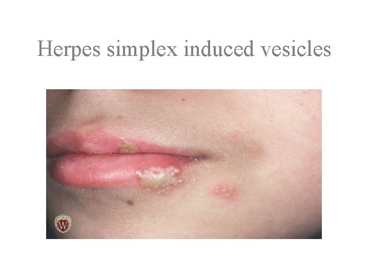 Herpes simplex induced vesicles 