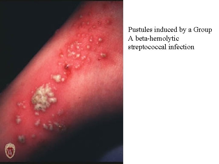 Pustules induced by a Group A beta-hemolytic streptococcal infection 