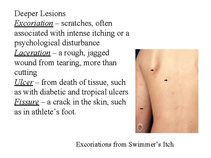 Deeper Lesions Excoriation – scratches, often associated with intense itching or a psychological disturbance