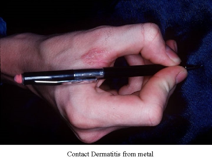 Contact Dermatitis from metal 