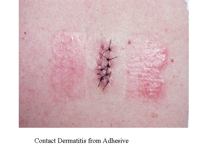 Contact Dermatitis from Adhesive 