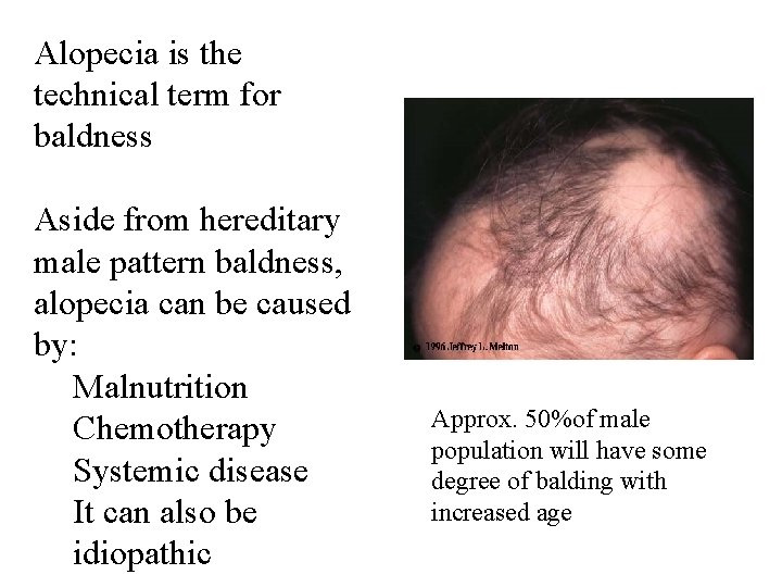 Alopecia is the technical term for baldness Aside from hereditary male pattern baldness, alopecia