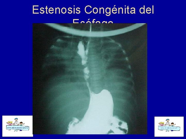 Estenosis Congénita del Esófago 