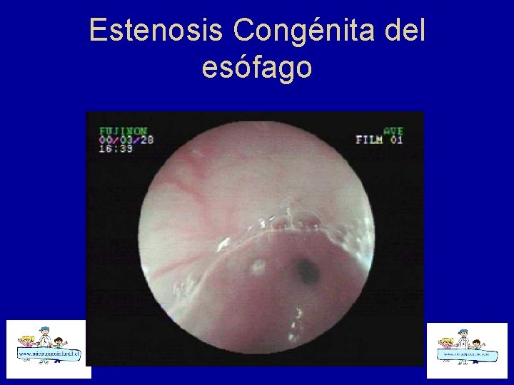 Estenosis Congénita del esófago 