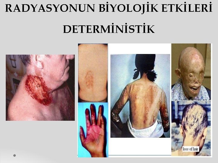 RADYASYONUN BİYOLOJİK ETKİLERİ DETERMİNİSTİK 