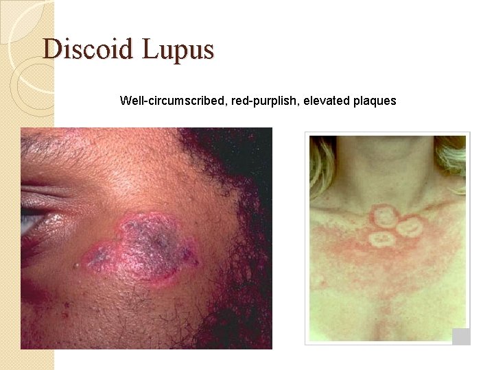 Discoid Lupus Well-circumscribed, red-purplish, elevated plaques Discoid Lupus Well-circumscribed, red-purplish, elevated plaques