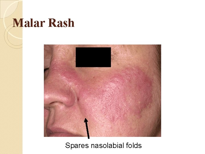 Malar Rash Spares nasolabial folds Malar Rash Spares nasolabial folds