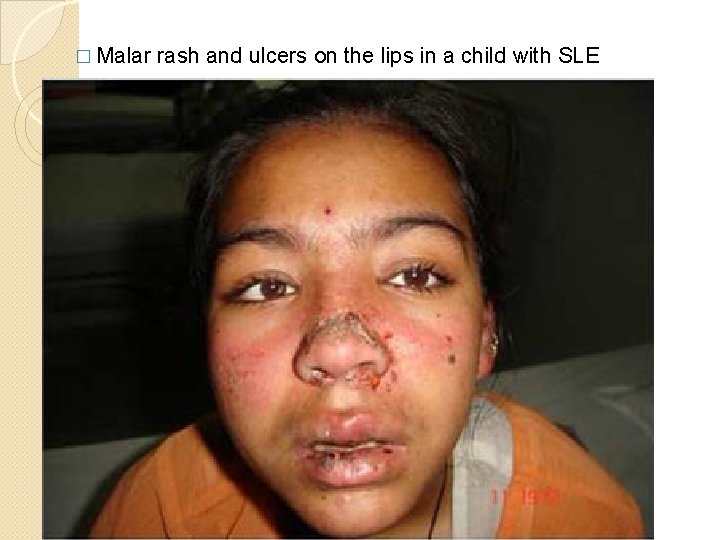 � Malar rash and ulcers on the lips in a child with SLE � Malar rash and ulcers on the lips in a child with SLE