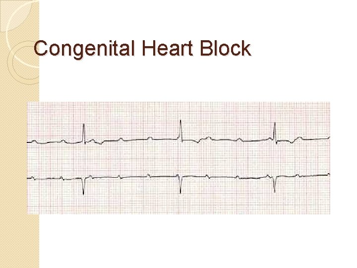 Congenital Heart Block Congenital Heart Block