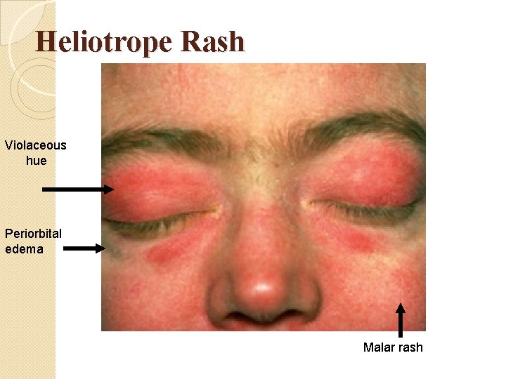 Heliotrope Rash Violaceous hue Periorbital edema Malar rash Heliotrope Rash Violaceous hue Periorbital edema Malar rash