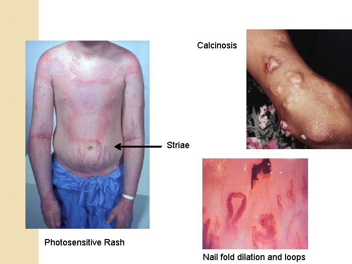 Calcinosis Striae Photosensitive Rash Nail fold dilation and loops Calcinosis Striae Photosensitive Rash Nail fold dilation and loops