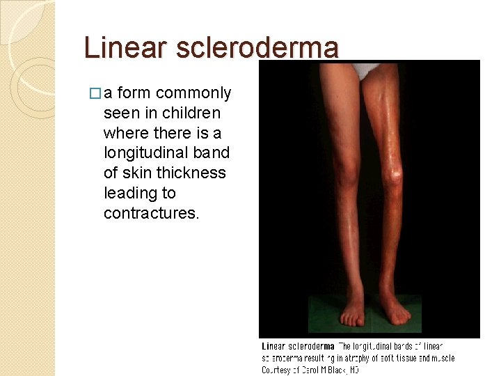 Linear scleroderma �a form commonly seen in children where there is a longitudinal band Linear scleroderma �a form commonly seen in children where there is a longitudinal band