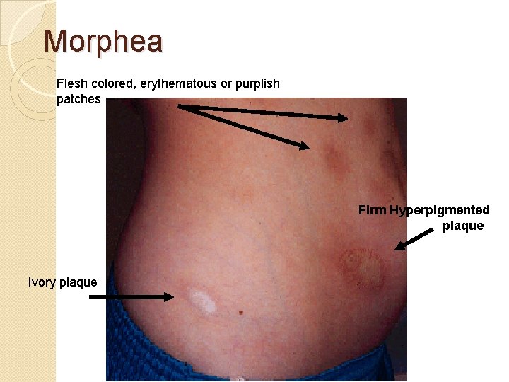 Morphea Flesh colored, erythematous or purplish patches Firm Hyperpigmented plaque Ivory plaque Morphea Flesh colored, erythematous or purplish patches Firm Hyperpigmented plaque Ivory plaque