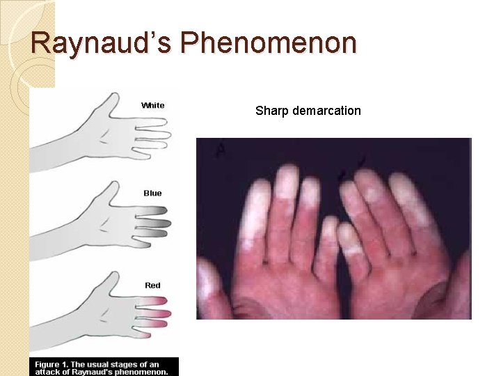 Raynaud’s Phenomenon Sharp demarcation Raynaud’s Phenomenon Sharp demarcation
