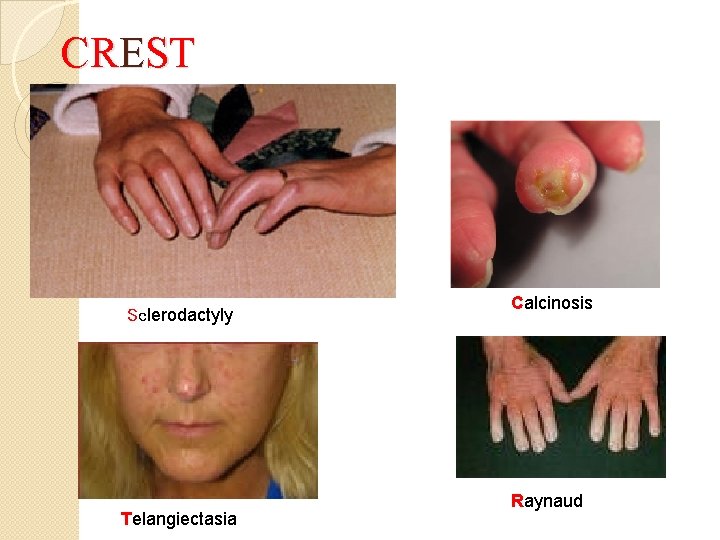 CREST Sclerodactyly Telangiectasia Calcinosis Raynaud CREST Sclerodactyly Telangiectasia Calcinosis Raynaud